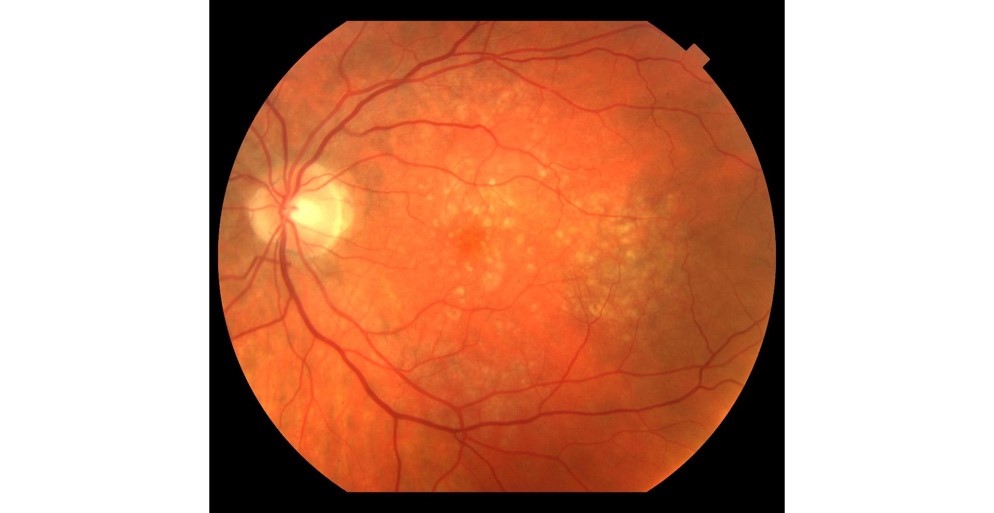 Early stage dry AMD