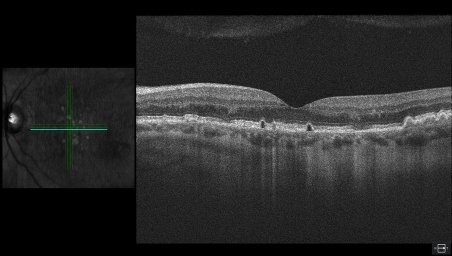 Early stage dry AMD OCT