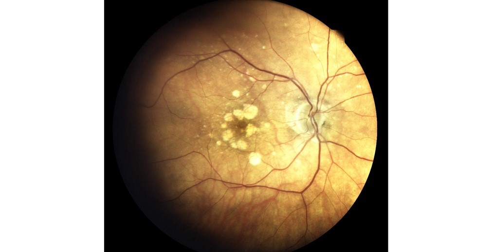 Advanced dry AMD