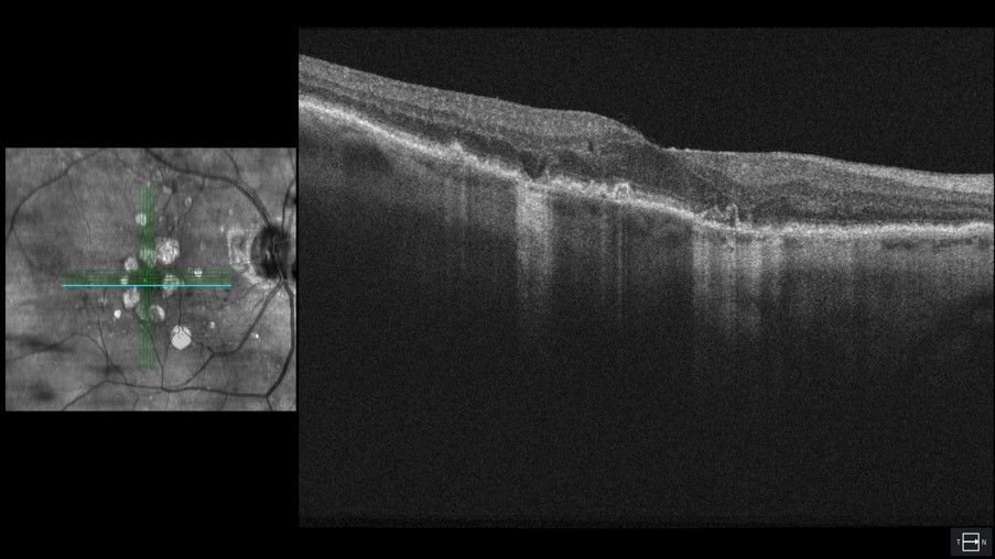 Advanced dry AMD OCT