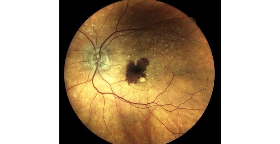Wet AMD