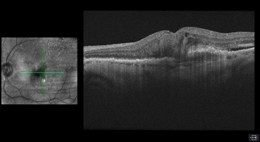 Wet AMD OCT